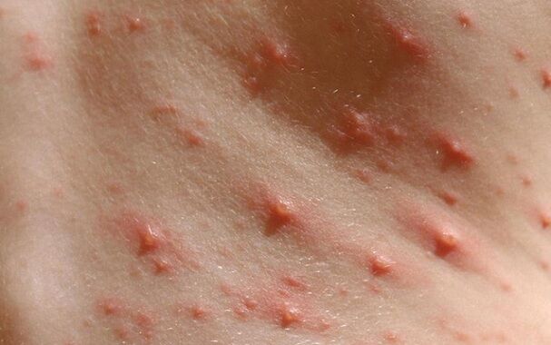 Bị đậu mùa khỉ cách ly tối thiểu 14 ngày khác ra sao với cách ly nhiễm COVID-19?