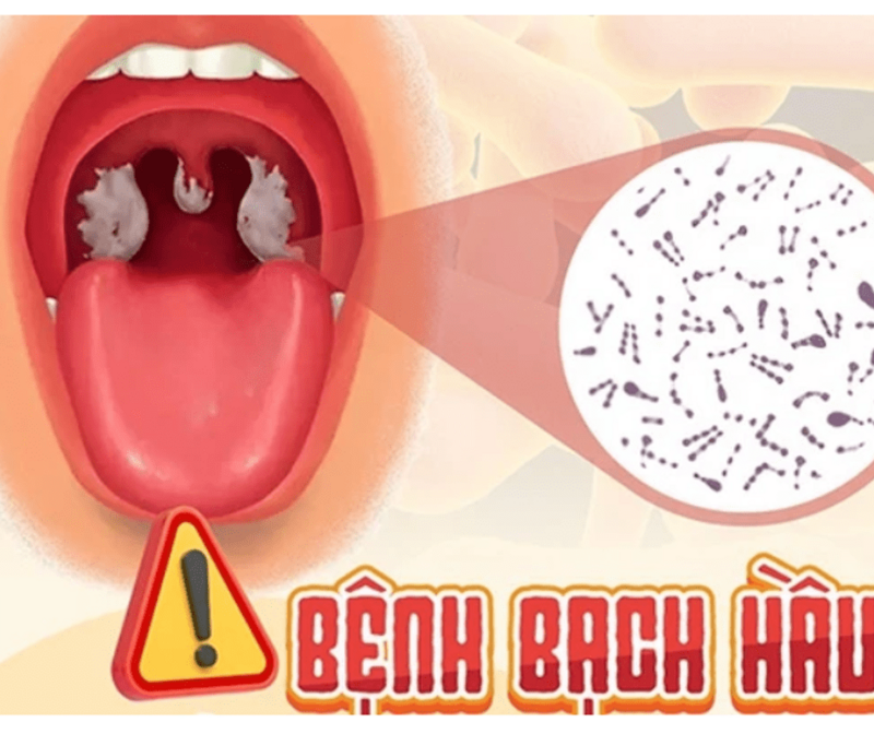 BẠCH HẦU - CĂN BỆNH KHÔNG THỂ CHỦ QUAN