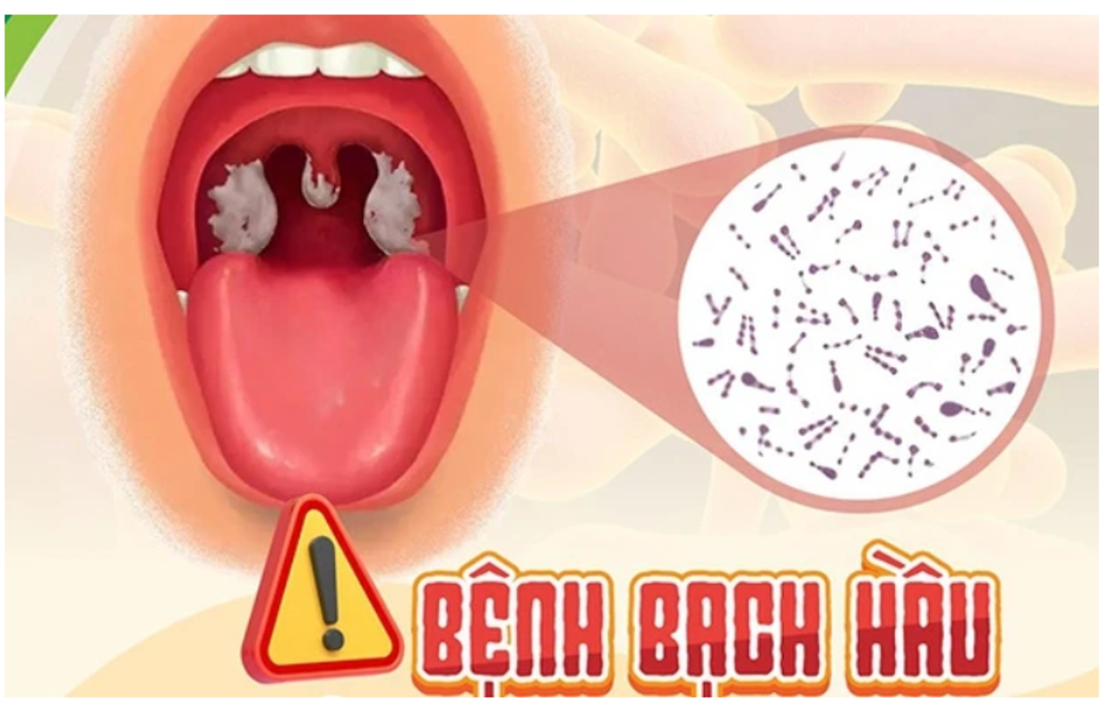 BẠCH HẦU - CĂN BỆNH KHÔNG THỂ CHỦ QUAN